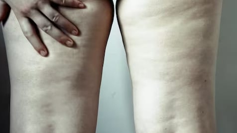 Oxigenoterapia hiperbárica no lipedema: como a OHB pode reduzir dor, inflamação e melhorar a qualidade de vida