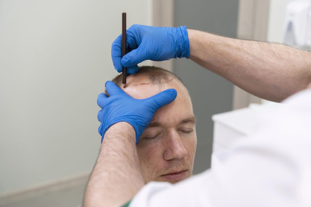 Benefícios da Oxigenoterapia Hiperbárica no transplante capilar e na recuperação dos pacientes