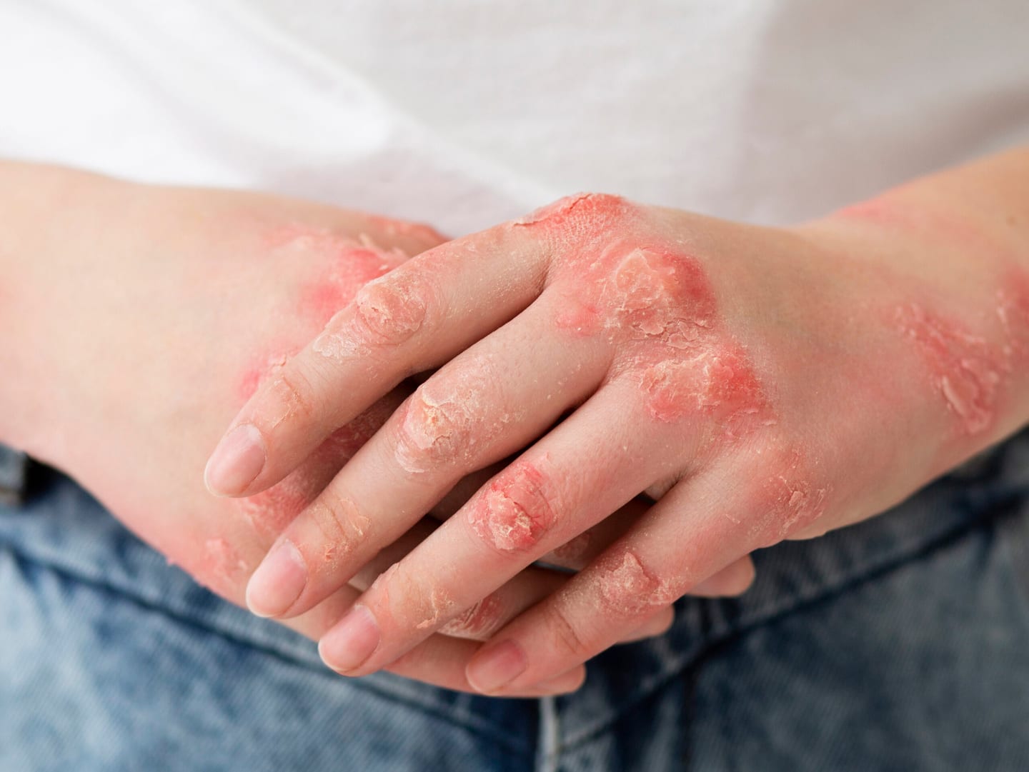Câmara Hiperbárica e Queimaduras: como a Oxigenoterapia Hiperbárica acelera a cicatrização