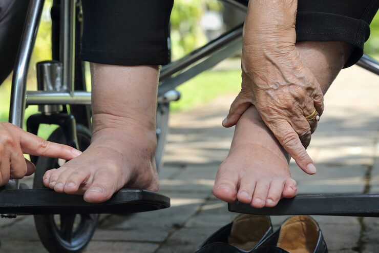 Brasil bate recorde de amputações por diabetes: como a oxigenoterapia hiperbárica pode ajudar a mudar esse cenário