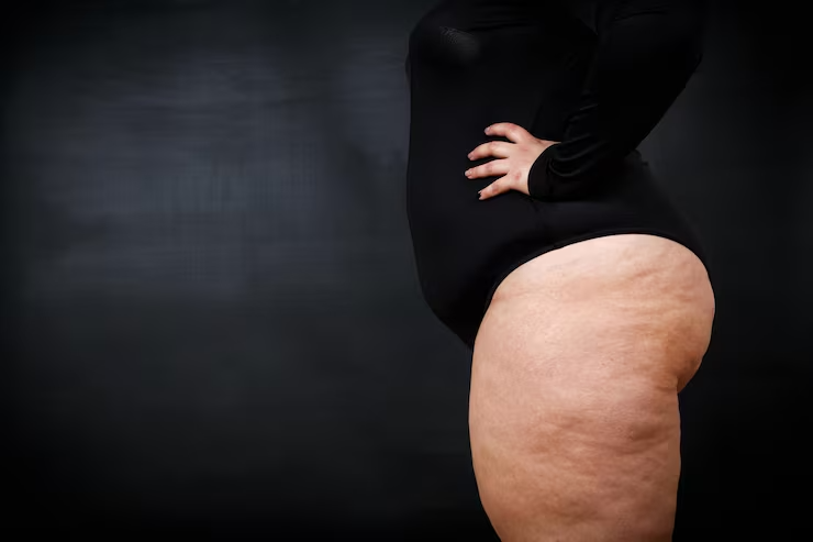 Oxigenoterapia hiperbárica no lipedema
